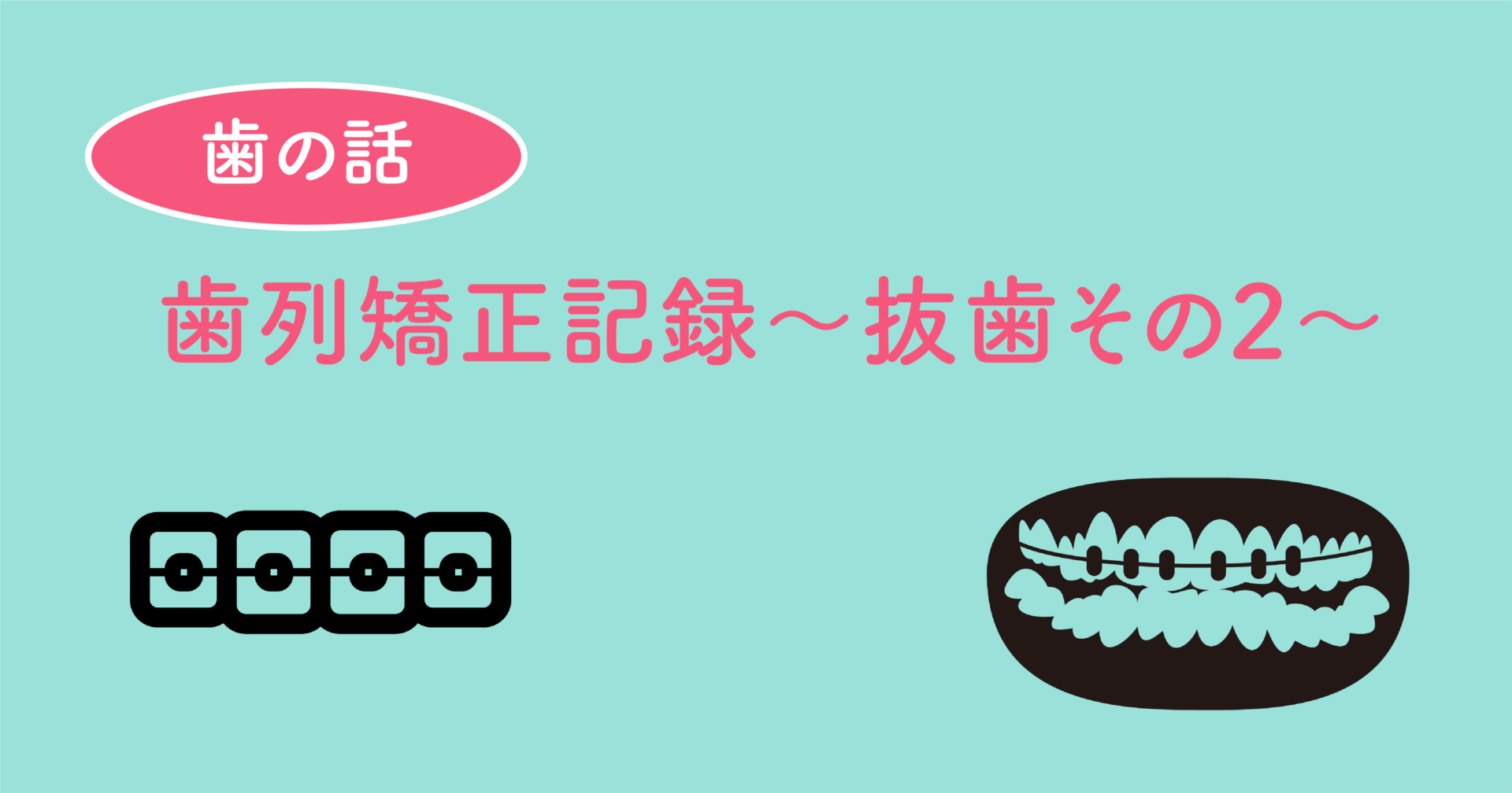 歯列矯正記録〜抜歯その2〜